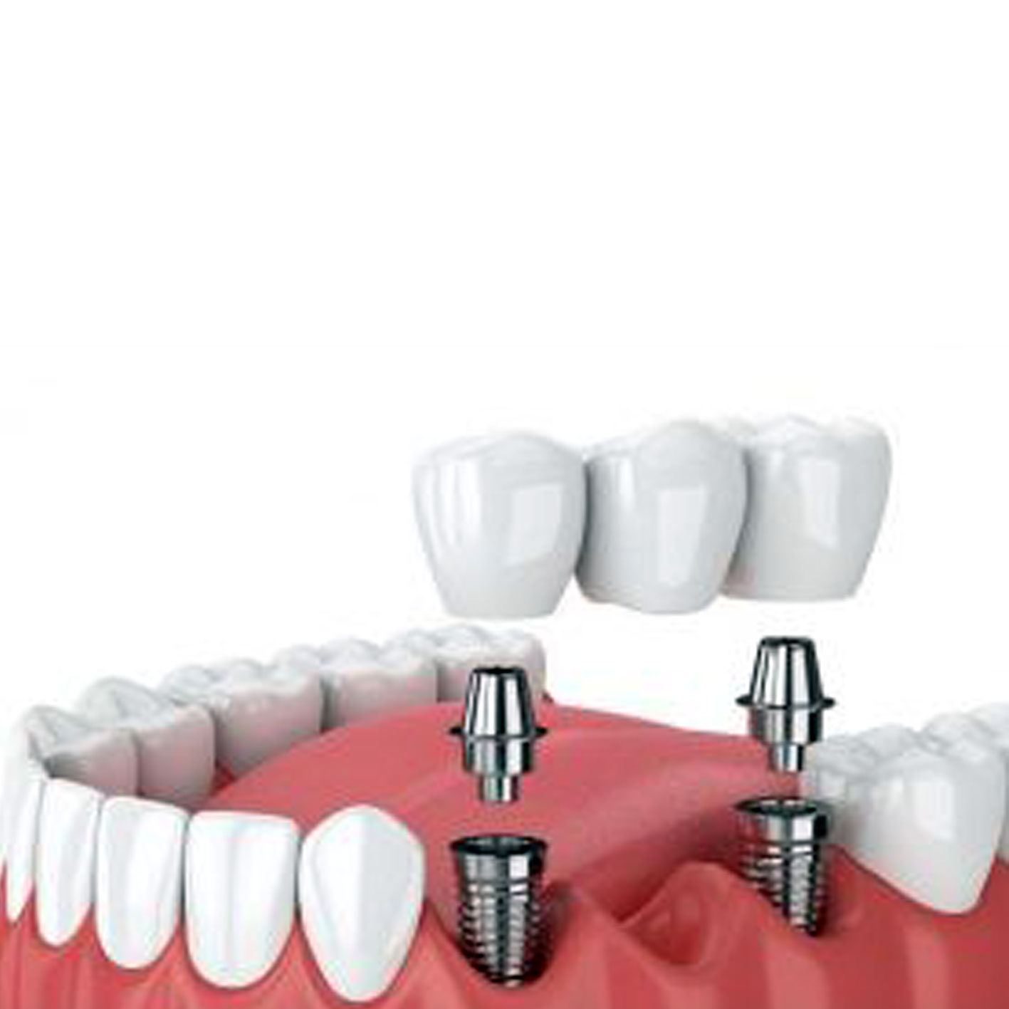 پروتز دندانی ثابت